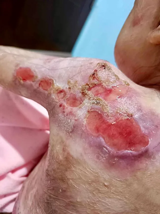 Close-up of raw wounds and blisters on Shamila’s arm