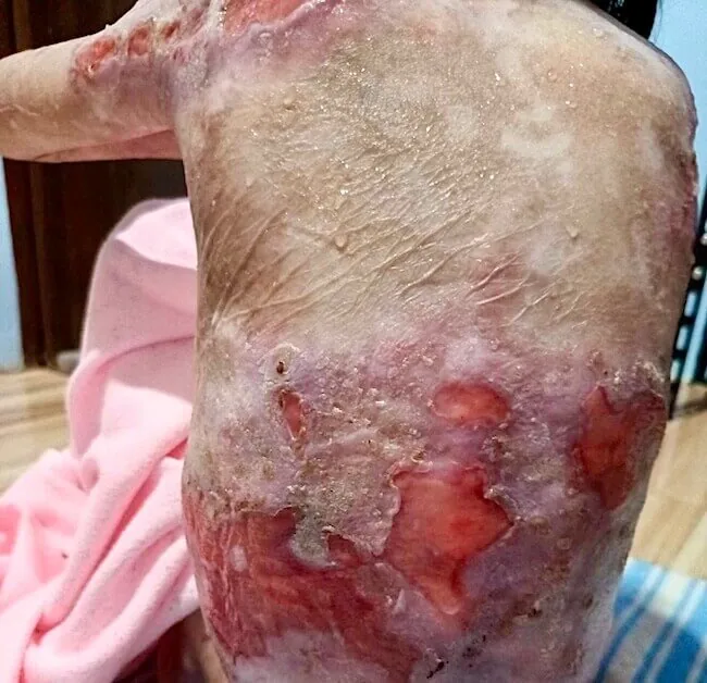 Close-up of open, blistered wounds on Shamila’s skin